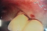 Experte Zahnimplantate Berlin Dr. Stoltenburg M.Sc.,M.Sc.,MPI /T&auml;tigkeitsschwerpunkt Implantologie
